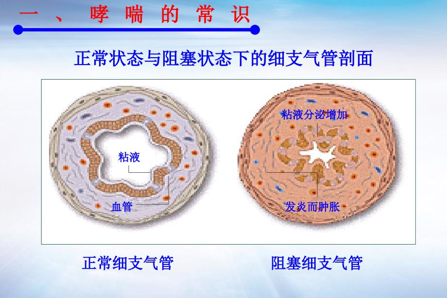 哮喘患者教育讲课PPT课件_第4页