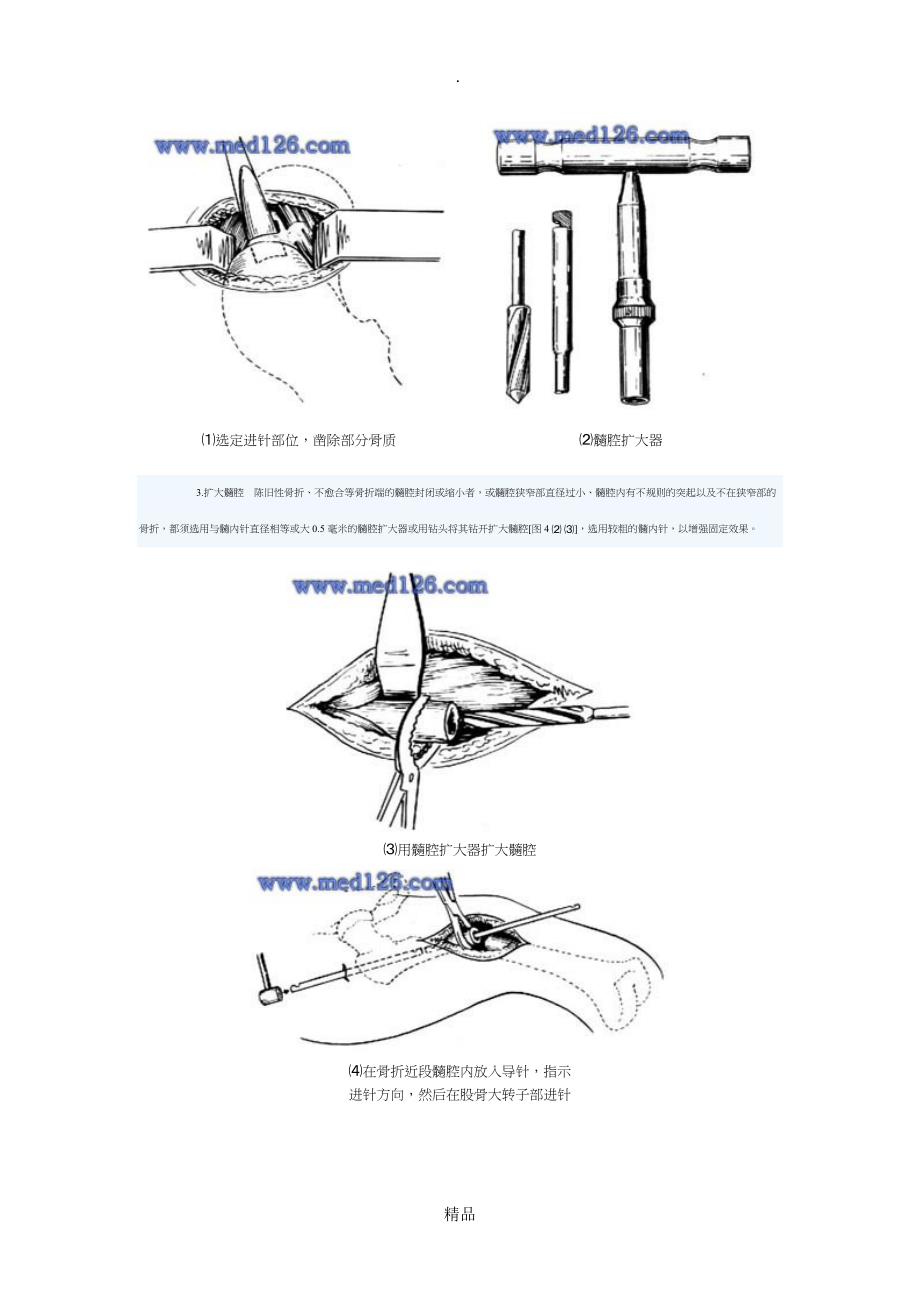 髓内针内固定手术_第5页