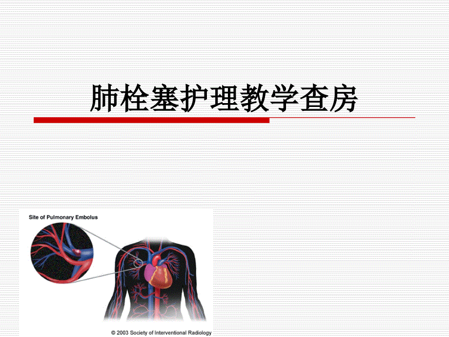 肺栓塞护理查房课件_第2页