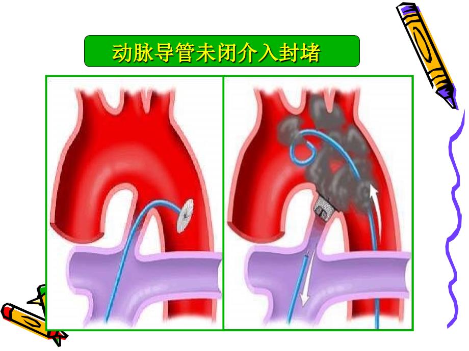 从介入医生角度论先心病合理化治疗_第3页