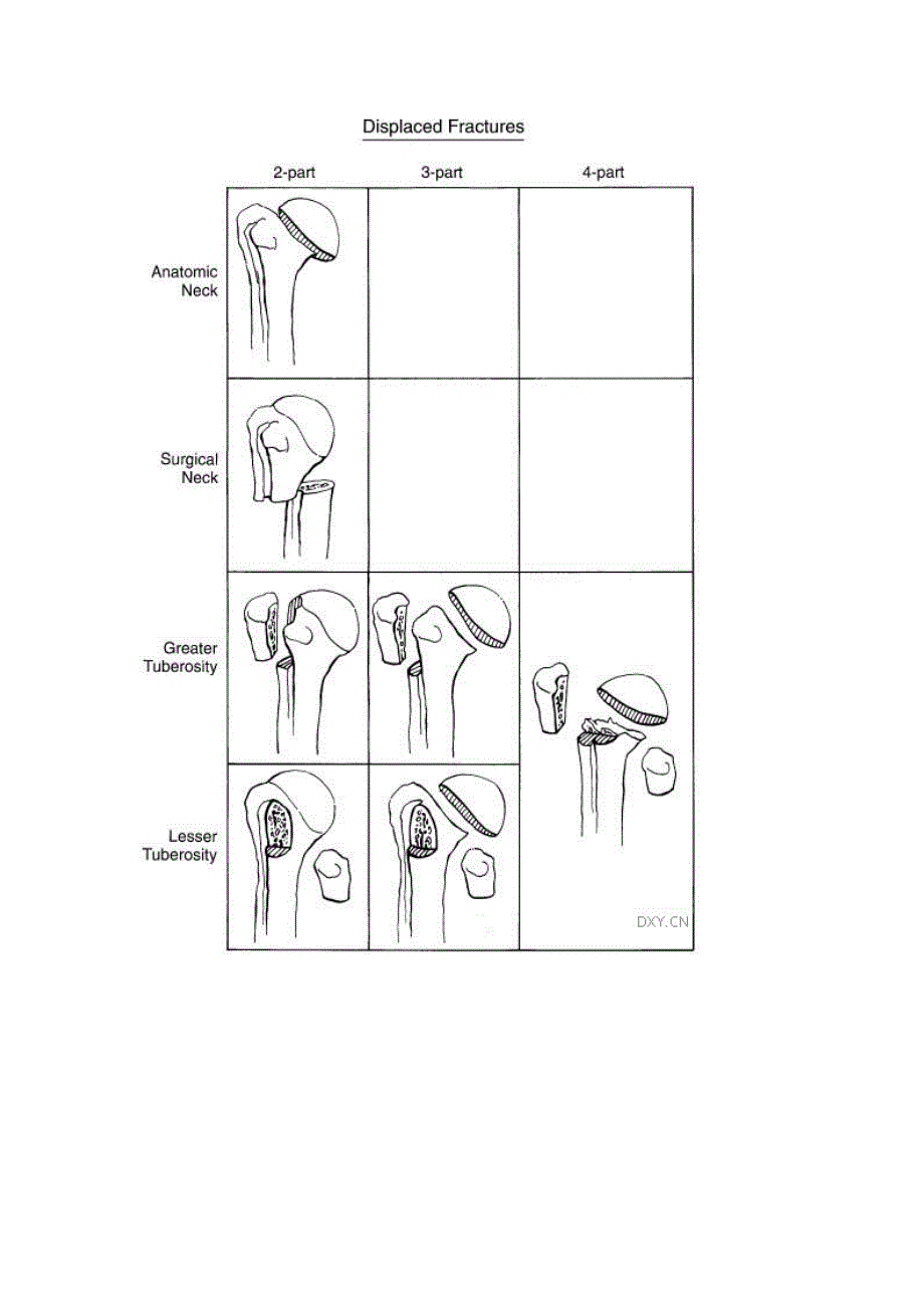 肩关节neer分型.doc_第4页