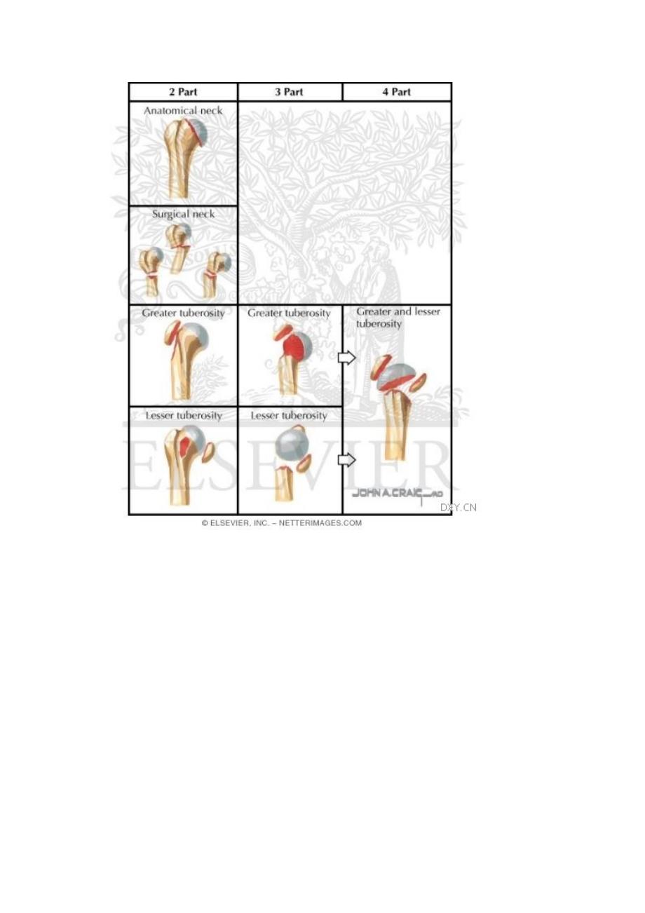 肩关节neer分型.doc_第5页
