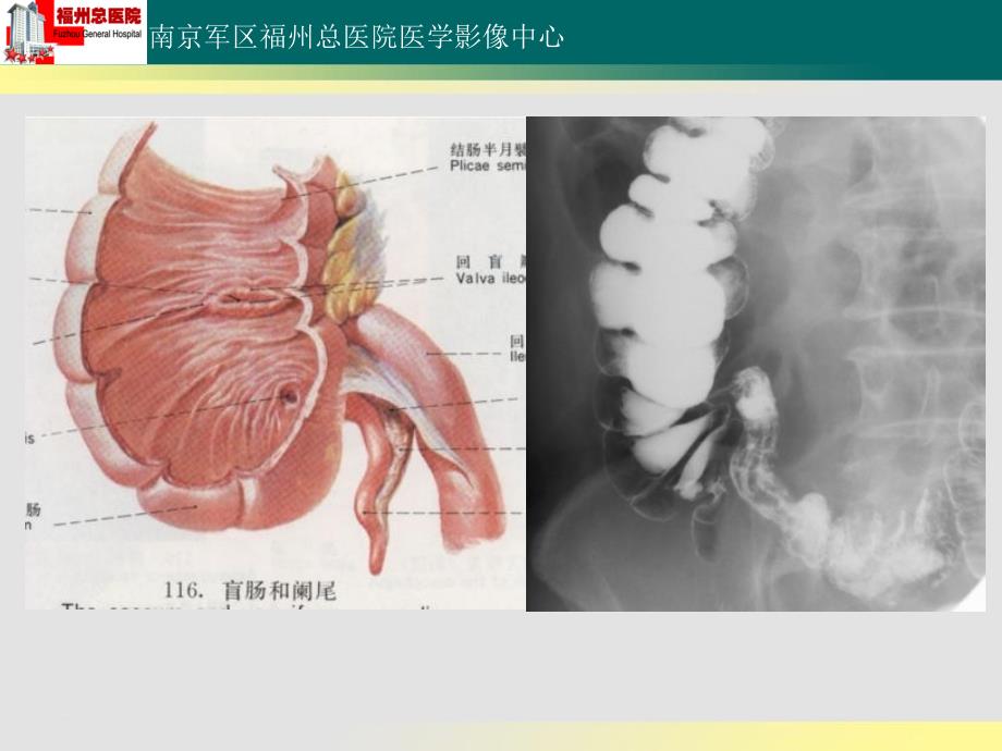 回盲部解剖特点及其病变的影像诊断_第3页