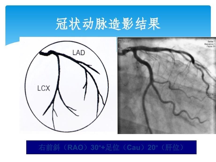 心脏介入治疗课件_第5页