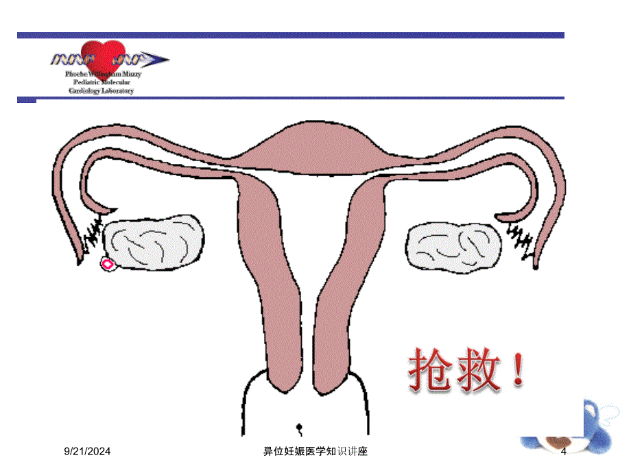 异位妊娠医学知识讲座培训课件_第4页