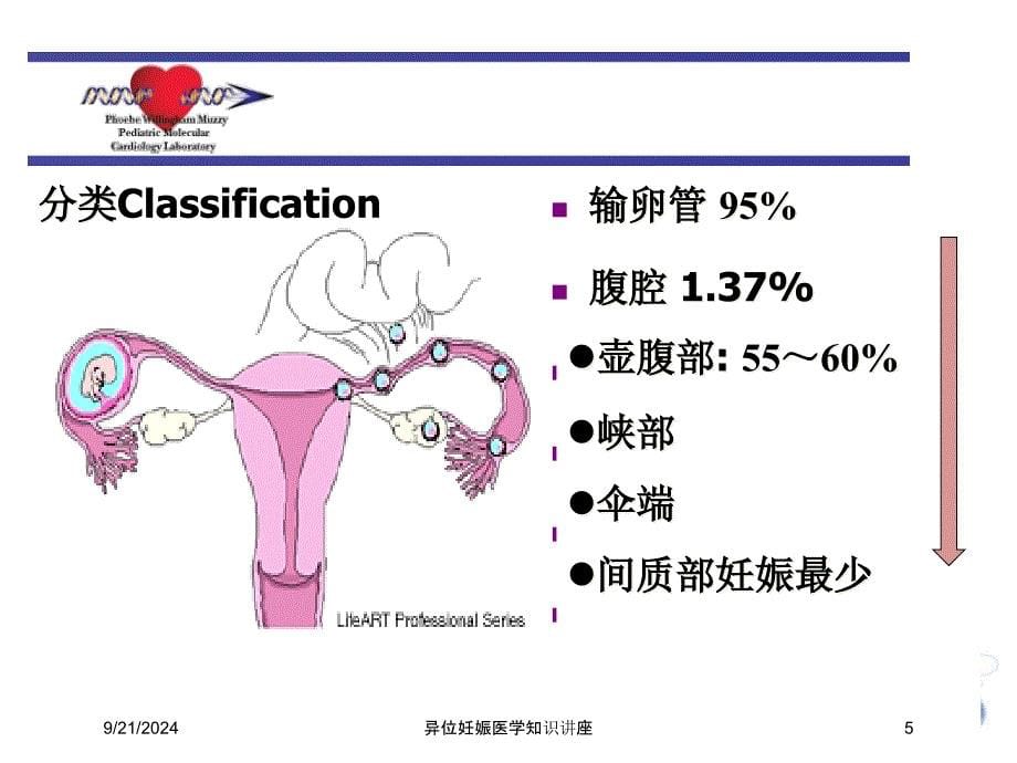 异位妊娠医学知识讲座培训课件_第5页