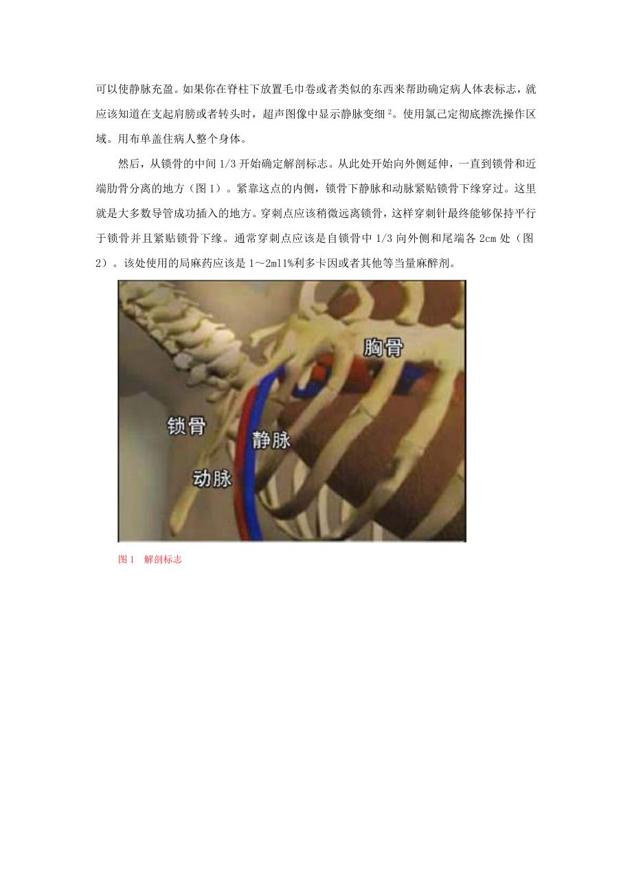 中心静脉插管——锁骨下静脉.doc_第2页