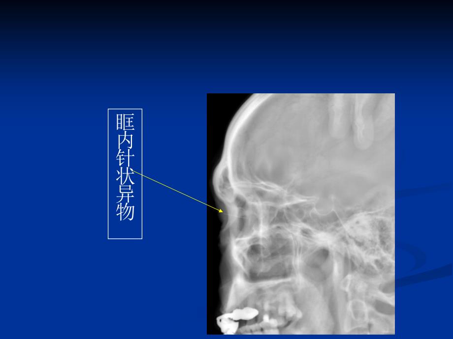 医学影像诊断学：鼻和鼻窦影像诊断 (2)_第2页