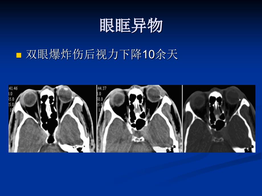 医学影像诊断学：鼻和鼻窦影像诊断 (2)_第3页