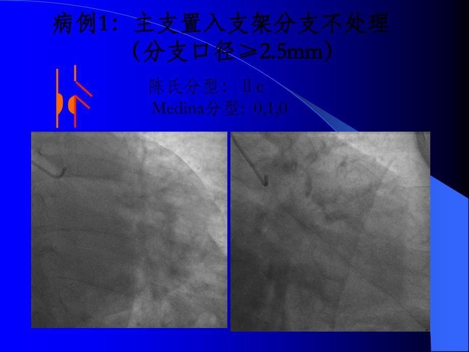 分叉病变的分支的保护策略_OK课件_第5页