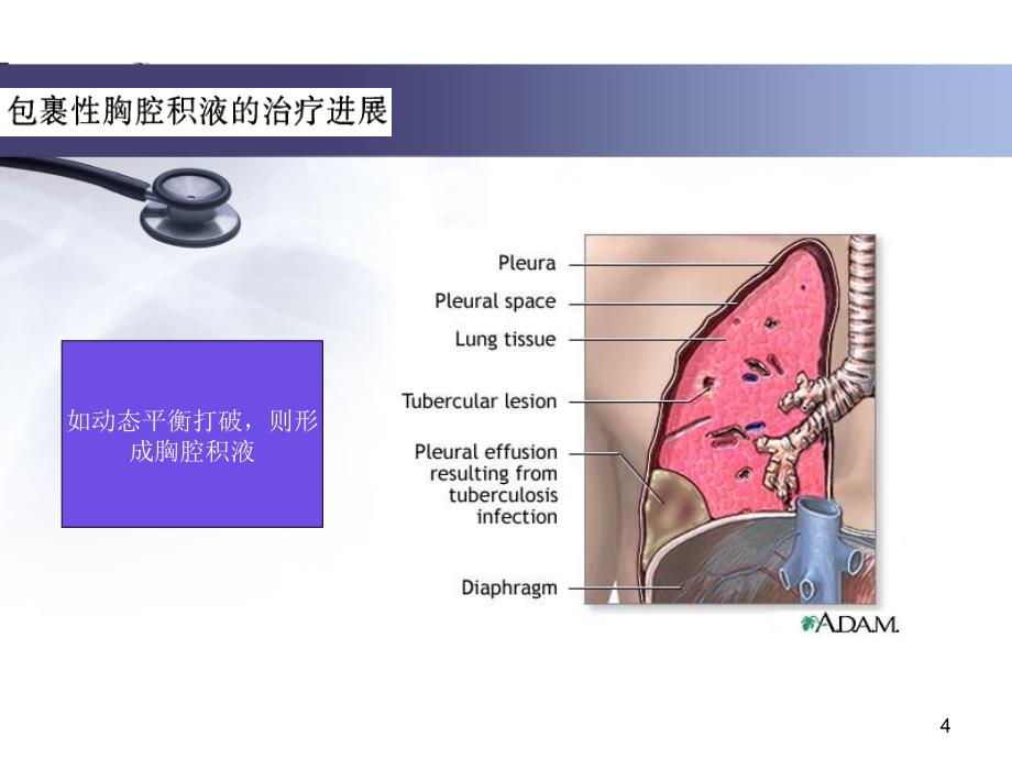 包裹性胸腔积液的治疗进展PPT课件_第4页