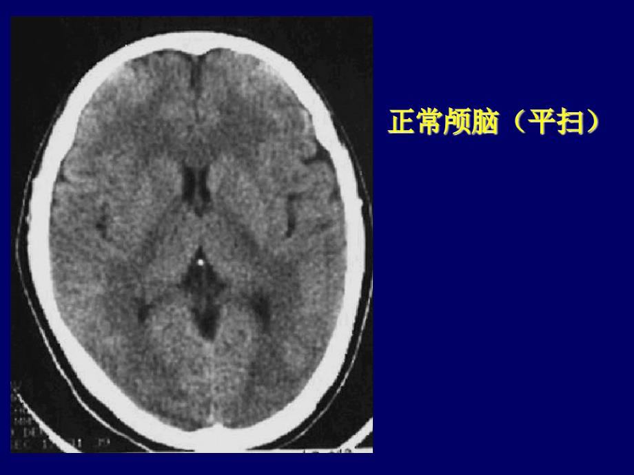 颅脑CT诊断读片_第2页