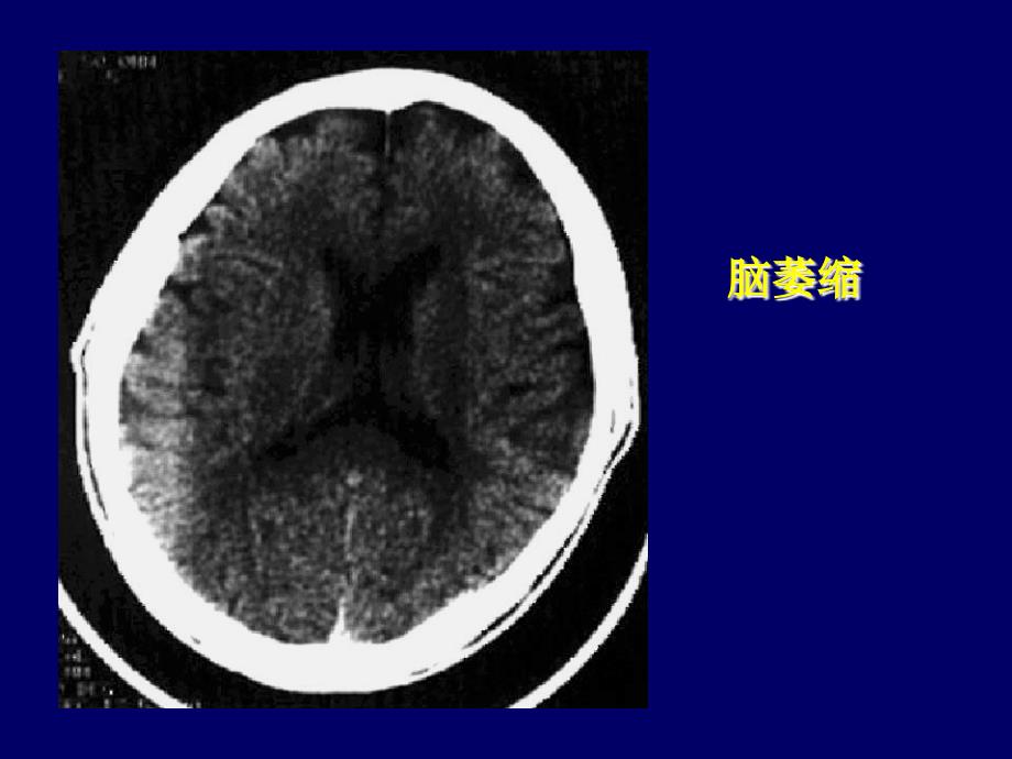 颅脑CT诊断读片_第4页