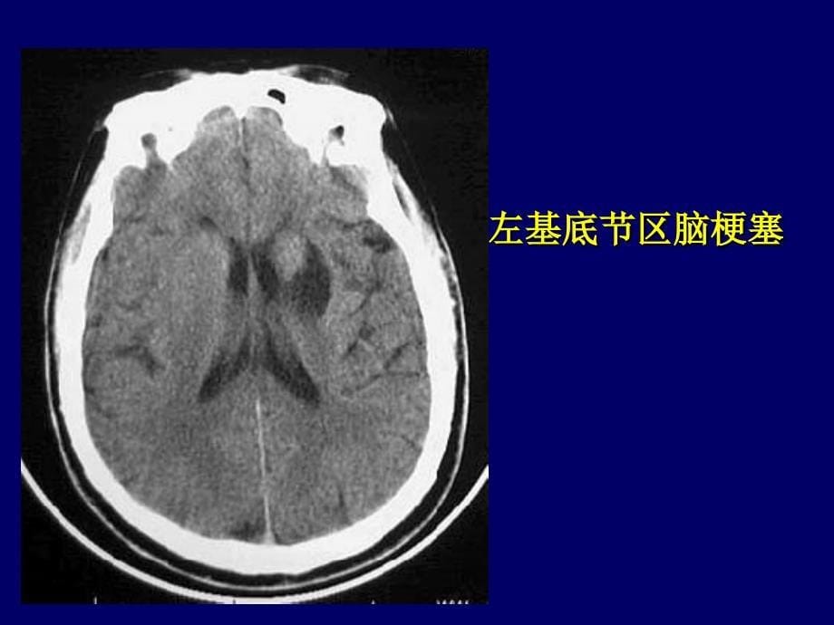 颅脑CT诊断读片_第5页