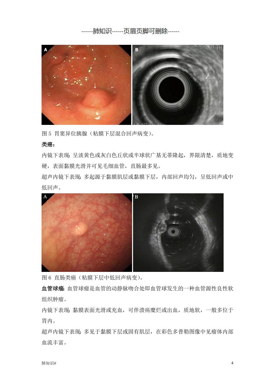 消化道黏膜下肿物白光内镜及超声内镜下特点#肺相关类_第4页