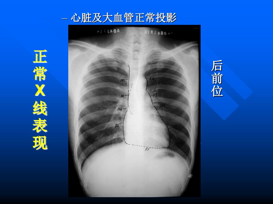 心脏常规x线检查ppt课件文档资料_第2页