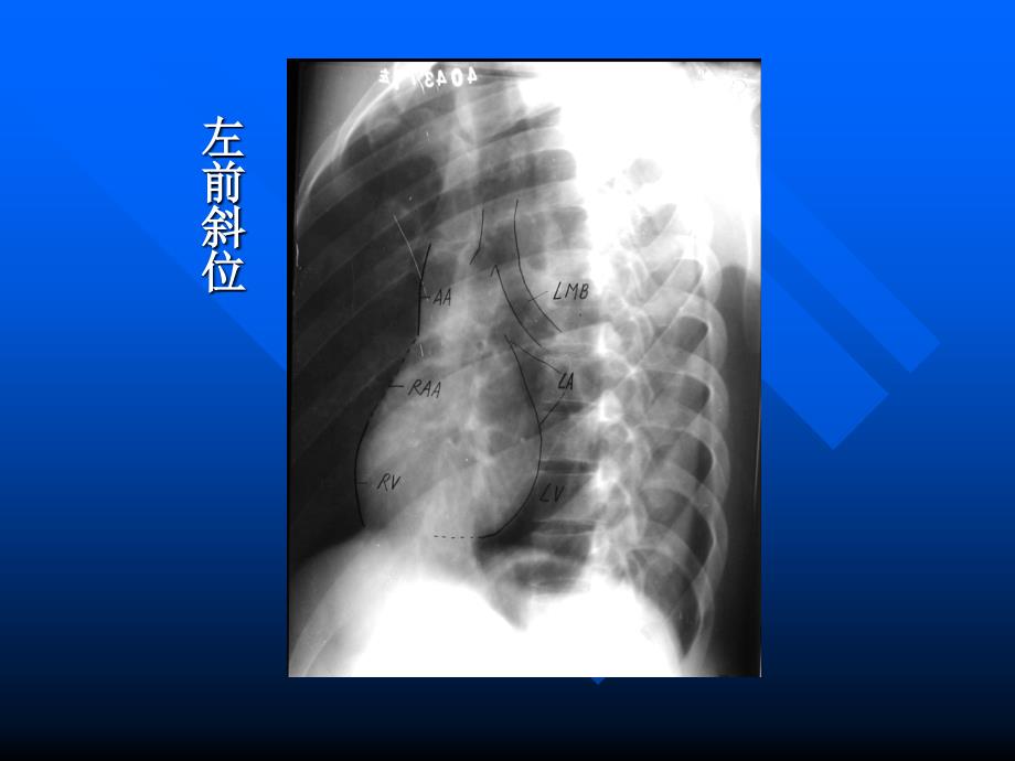 心脏常规x线检查ppt课件文档资料_第3页