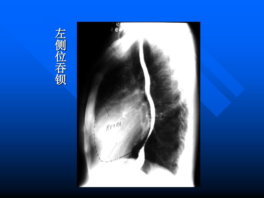 心脏常规x线检查ppt课件文档资料_第4页