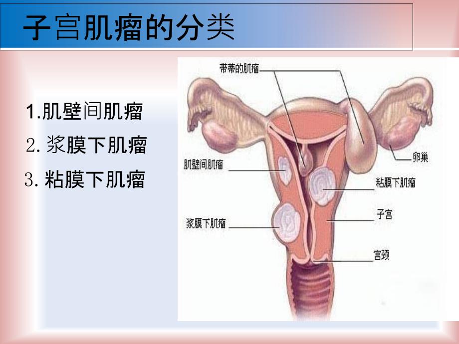 子宫肌瘤健康教育_第4页