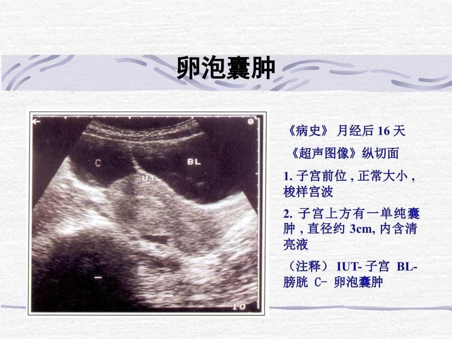 卵巢肿瘤的超声诊断课件_第5页