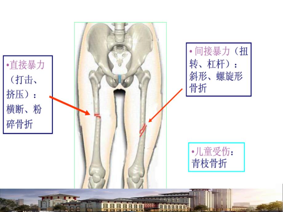 股骨干骨折的治疗（优质医学）_第4页