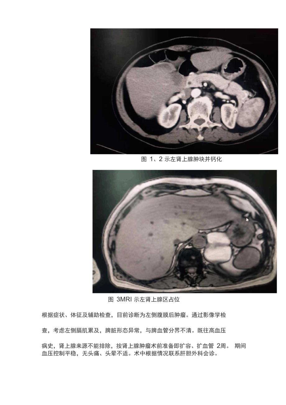 2022腹膜后肿瘤手术治疗全过程记录_第2页