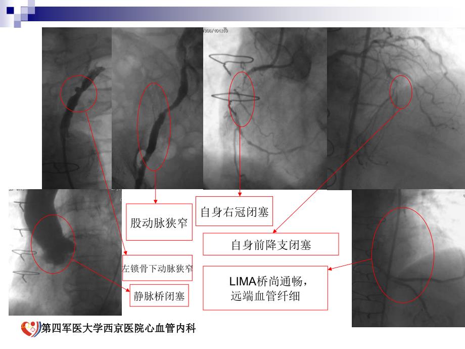 冠心病患者血糖异常管理_第2页