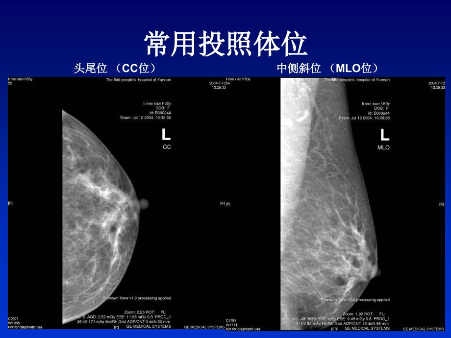 全数字化乳腺机的临床应用PPT文档_第2页