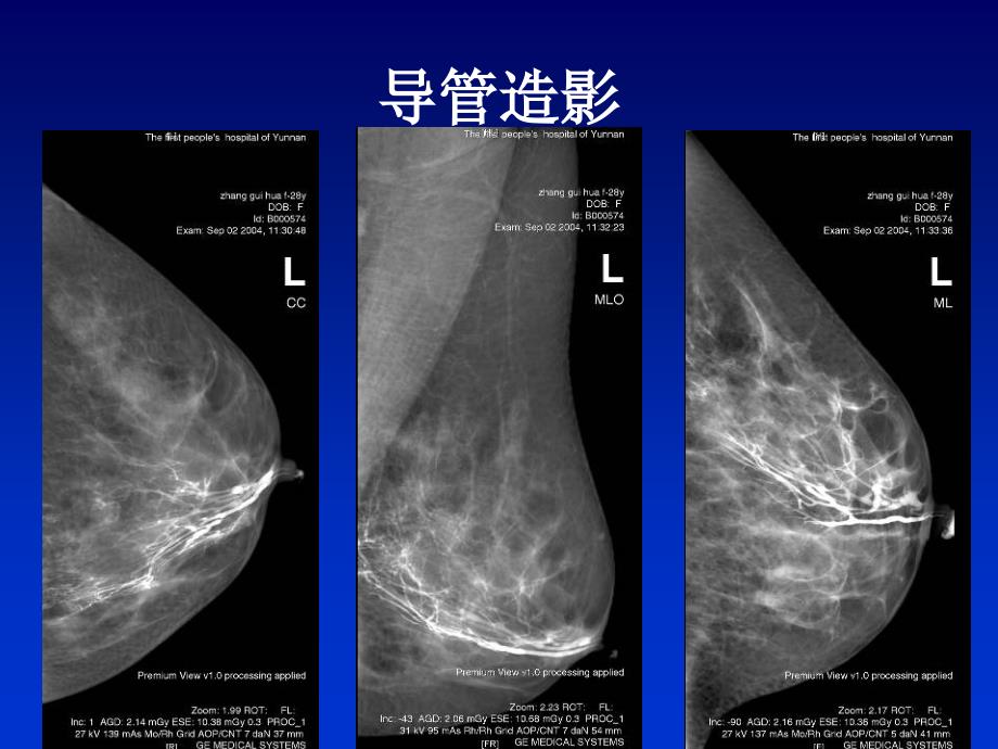 全数字化乳腺机的临床应用PPT文档_第4页