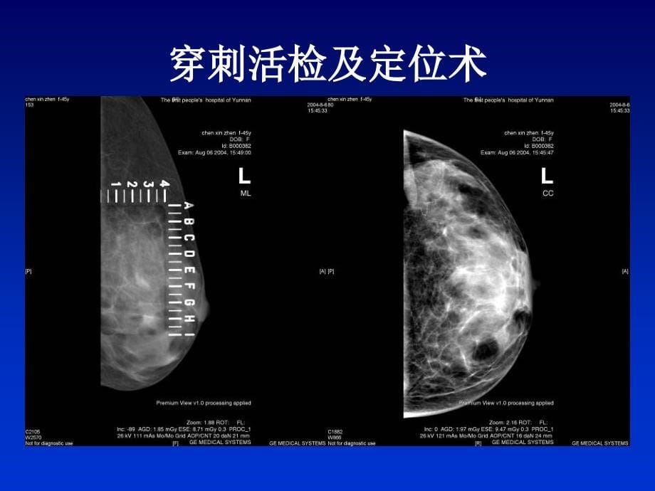 全数字化乳腺机的临床应用PPT文档_第5页