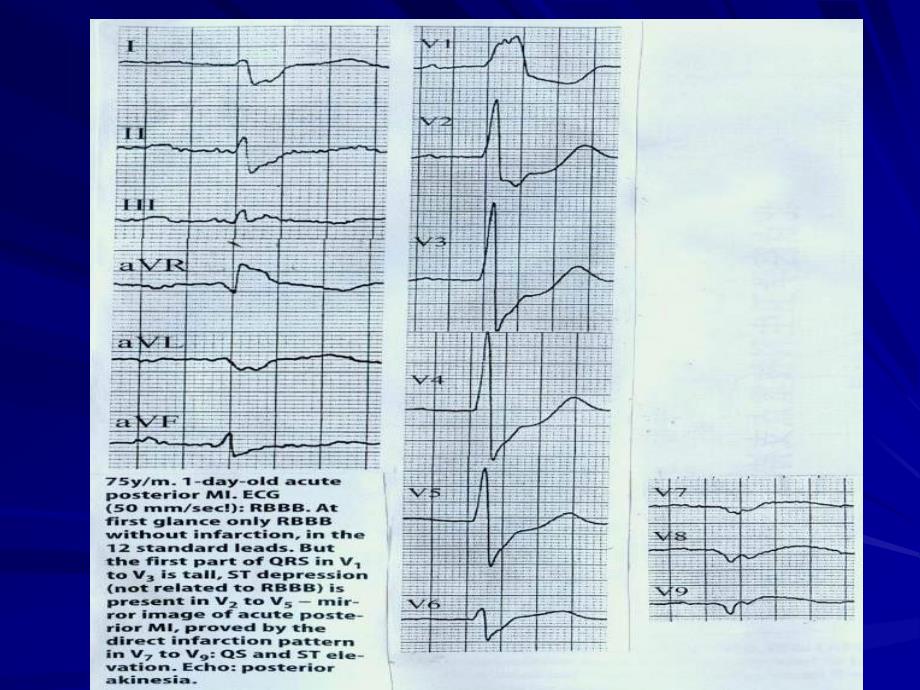 急性心肌梗死ami临床诊断存在的几问题_第3页