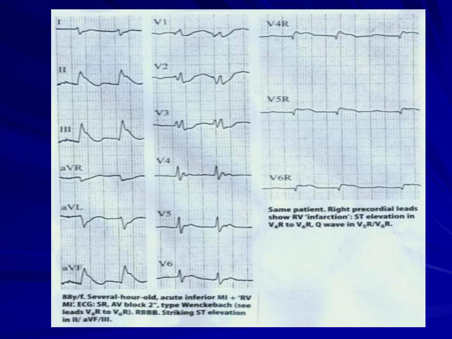 急性心肌梗死ami临床诊断存在的几问题_第4页