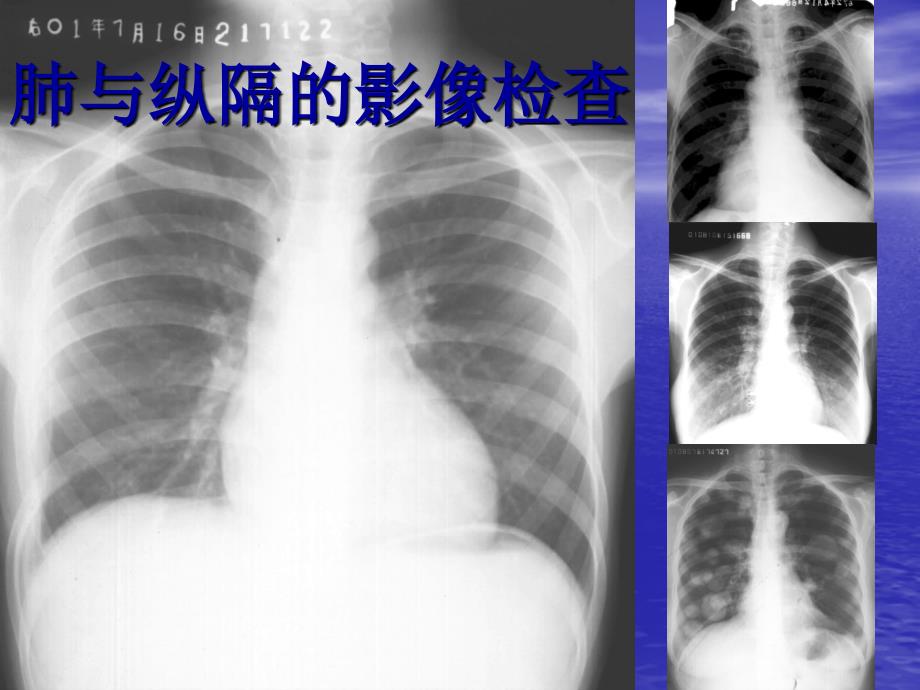 教你如何看肺部CT_第1页