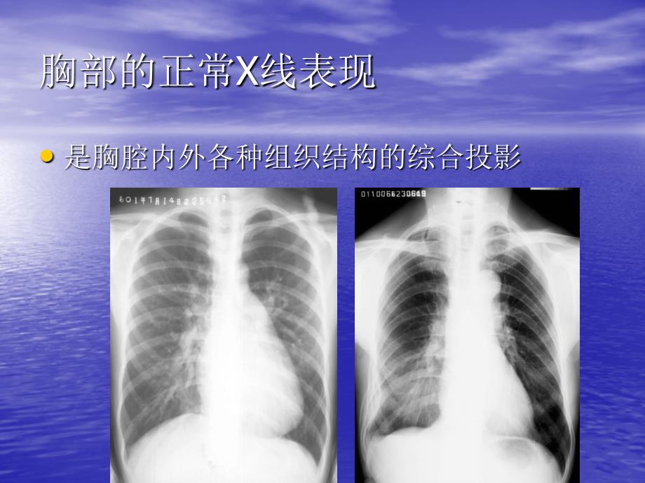 教你如何看肺部CT_第4页