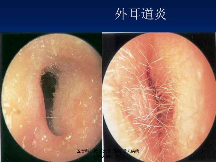 五官科护理-第六章(耳部)常见疾病病人的护理课件_第3页