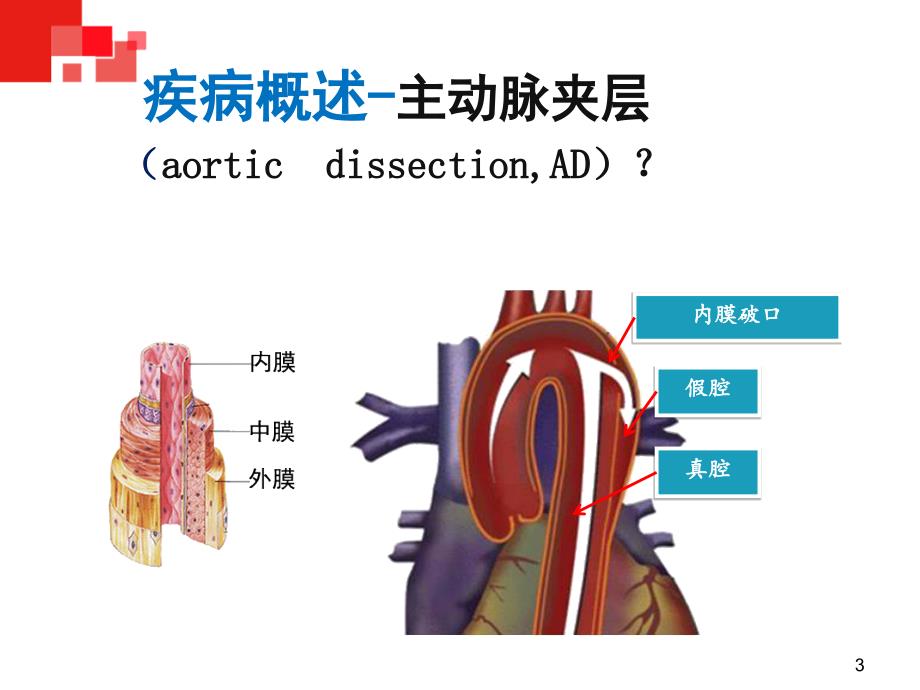 主动脉夹层讲课PPT课件1_第3页