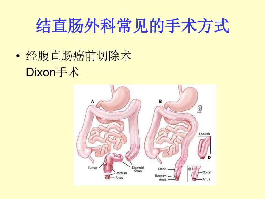 《结肠造口及其护理》PPT课件.ppt_第3页