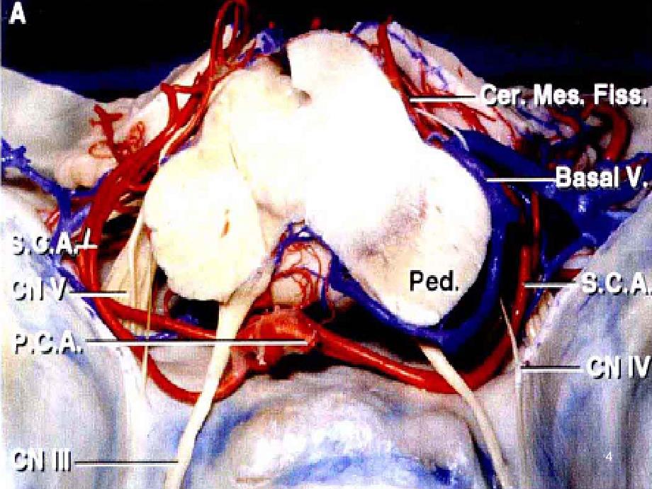 小脑动脉.ppt_第4页