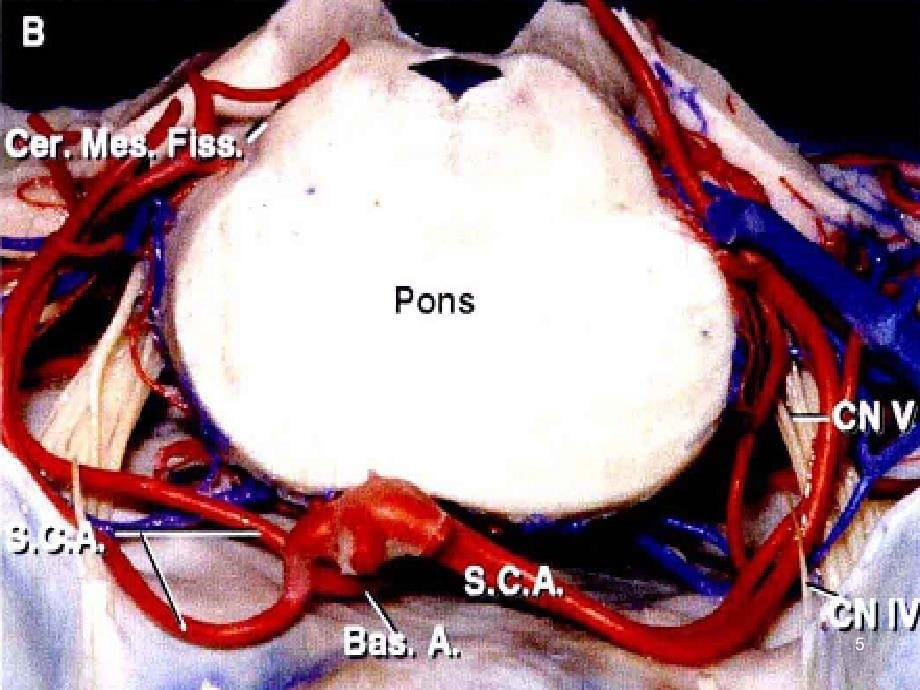 小脑动脉.ppt_第5页