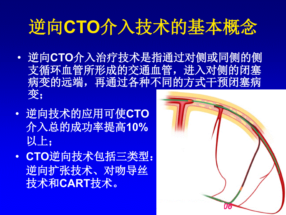 正向和逆向cto病变介入技术的选择_第3页