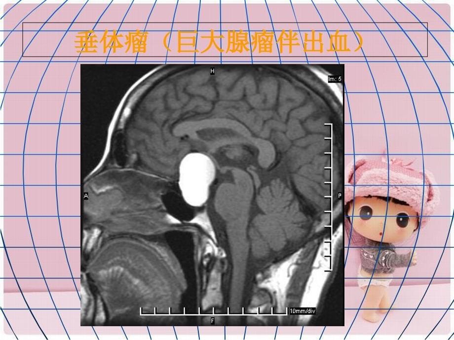 神经病学大脑小脑脊髓的结构和功能_第5页