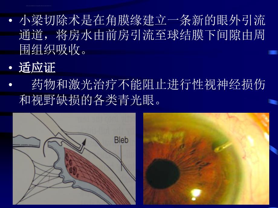 小梁切除术ppt课件_第1页