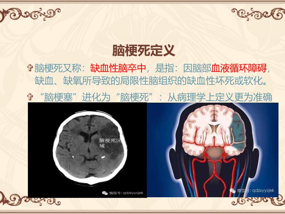 医学专题：如何正确认识脑梗塞.._第4页