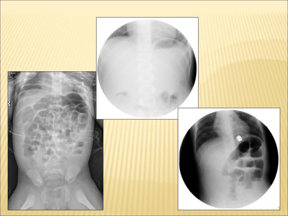 肠套叠X线诊断与复位ppt课件_第1页