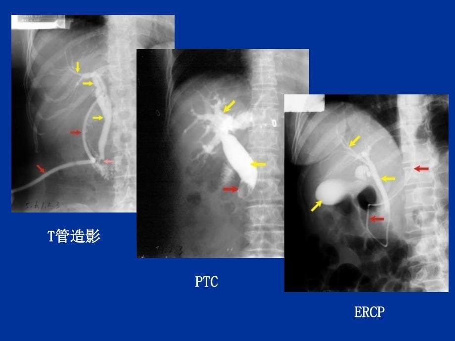 胆道疾病的影像学诊断ppt课件_第5页