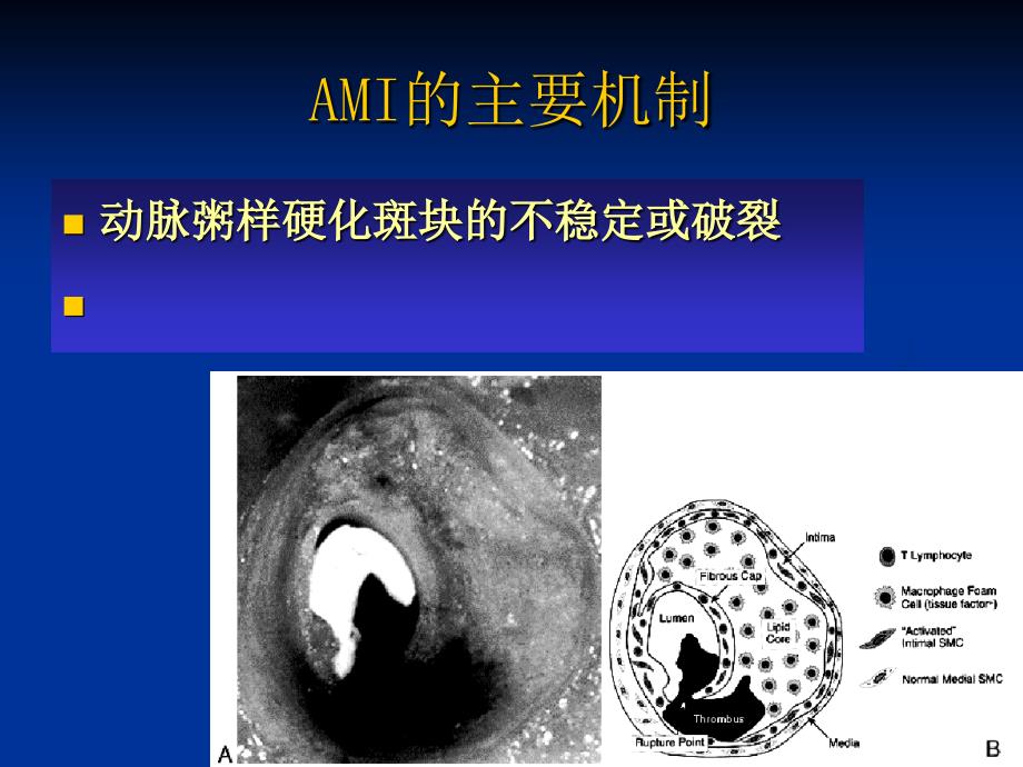 《AMI的溶栓治疗》PPT课件_第2页