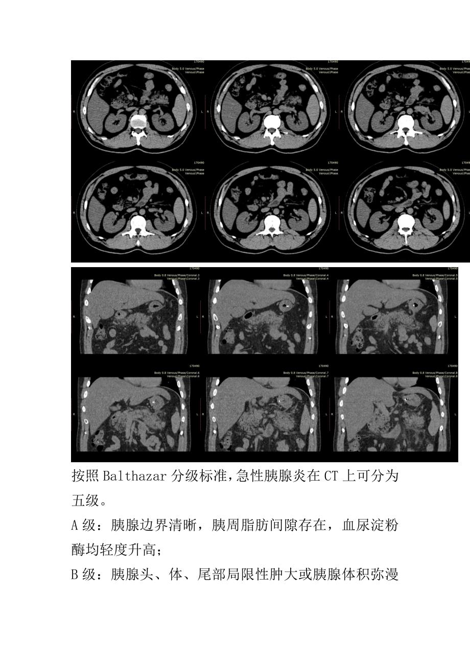 急性胰腺炎CT分级.doc_第3页