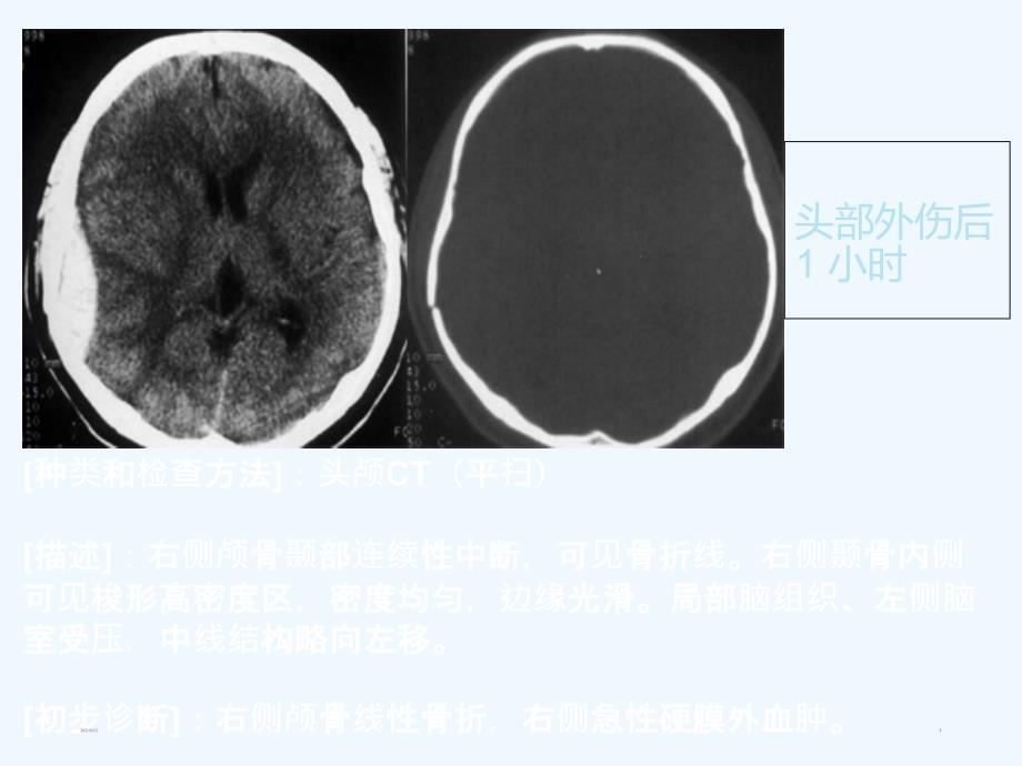 CT读片练习讲座_第1页