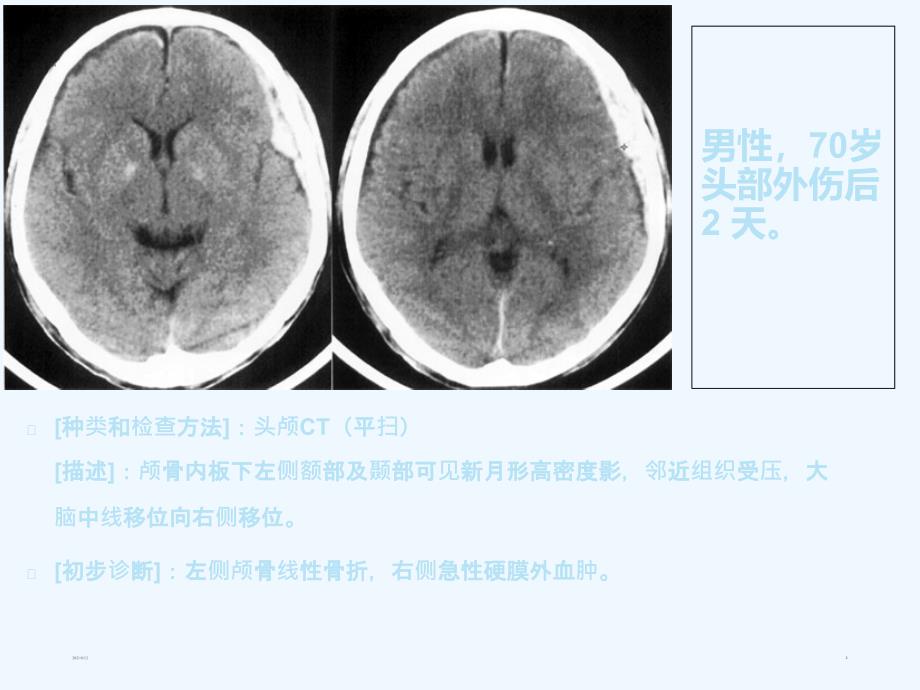 CT读片练习讲座_第2页