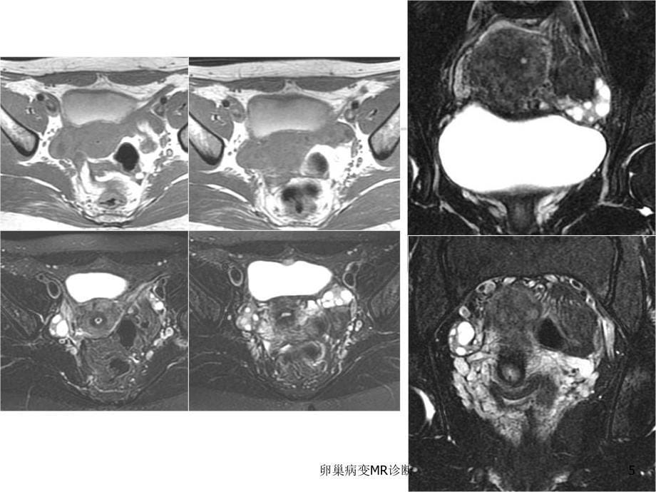 卵巢病变MR诊断培训课件_第5页